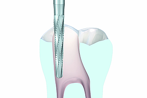 Entscheidende Teilschritte bei der Präparation der endodontischen Zugangskavität