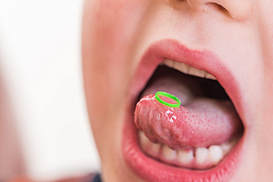 Sprachentwicklung bei Kindern: Zahnfehlstellung lässt lispeln