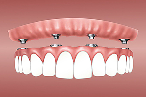 3D-Zahnimplantologie: immer sicherer, schonender, schneller 