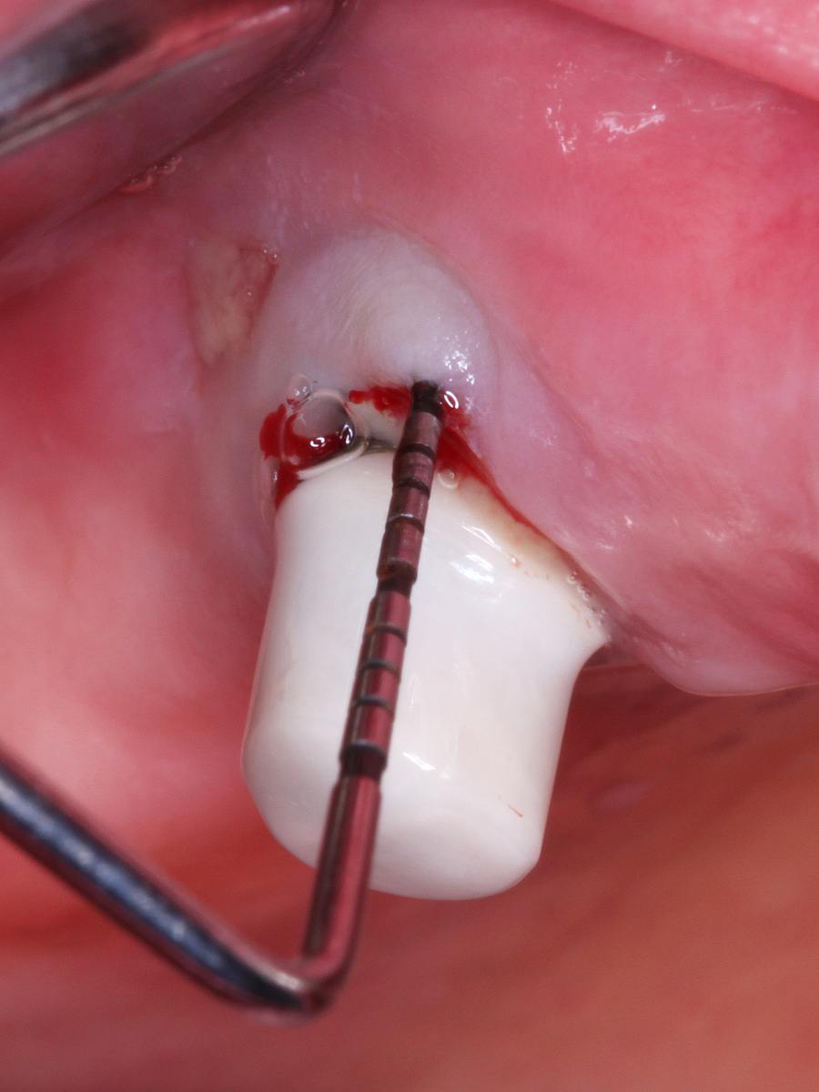 Zahnimplantate brauchen dieselbe Pflege wie natürliche Zähne