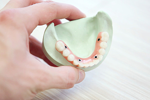 Senioren wollen „feste Zähne“ statt einer Prothese