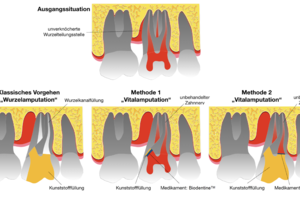 Auch mit zwei Wurzeln kann ein Zahn vital bleiben