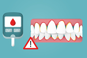 Patienteninfo zum Weltdiabetestag: Diabetes und Parodontitis sind ein gefährliches Duo!