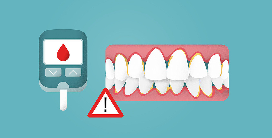 Patienteninfo zum Weltdiabetestag: Diabetes und Parodontitis sind ein gefährliches Duo!