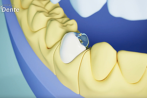 Erklärvideo für Patienten: So entsteht eine Zahnkrone