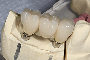 Implantate mit Mikrogewinde verbessern die Osseointegration