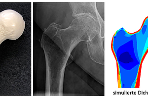 Mit Simulationen gegen den Knochenschwund