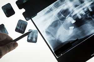 Britische Zahnärzte röntgen häufiger, wenn sie daran verdienen