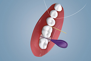 Wie wirksam sind Interdentalbürsten?