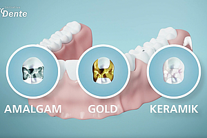 Erklärvideo für Patienten: Welche Zahnfüllungen gibt es?