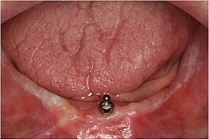 DFG-Förderung für weltweit größte Studie zu Einzel-Implantaten im zahnlosen Unterkiefer