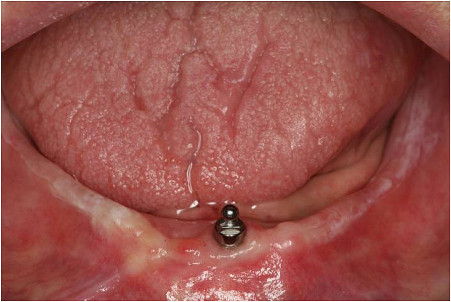 DFG-Förderung für weltweit größte Studie zu Einzel-Implantaten im zahnlosen Unterkiefer