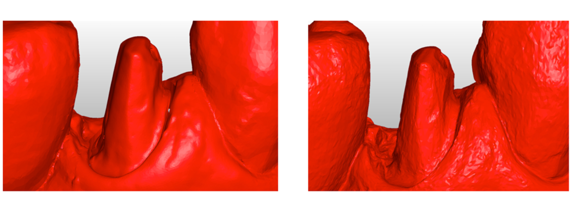 Die hohe Auflösung der STL-Datei beim iTero Element Scanner und die dadurch gegebene Zeichnungsschärfe (links) gegenüber dem Ergebnis eines anderen Scanners (rechts) ist die Voraussetzung für die Genauigkeit und Passung des zu fertigenden Zahnersatzes.