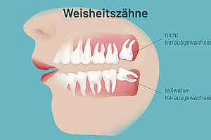 Weisheitszähne entfernen? Auf den Einzelfall kommt es an