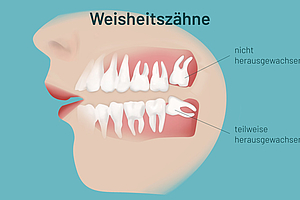 Patienteninfo: Weisheitszähne entfernen? Auf den Einzelfall kommt es an