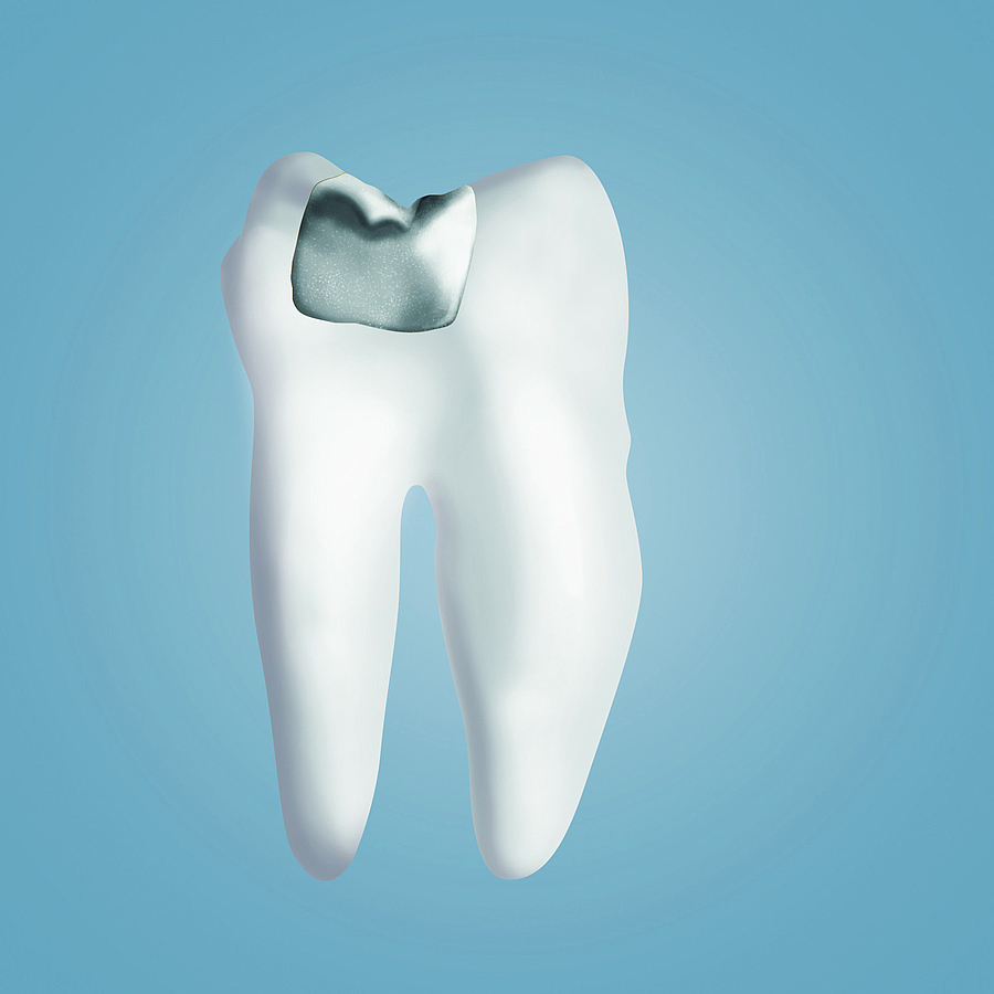 Kritik an Amalgam ist weder naturwissenschaftlich noch medizinisch begründbar
