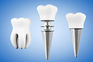 Das saubere Implantat – ein Mythos?