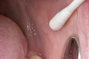 Drastisch veränderte Mundflora bei Krebs