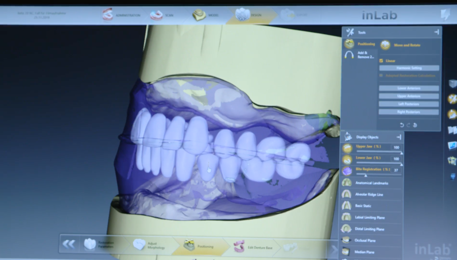 Totalprothese mit inLab Software 20.0 - einfach digital