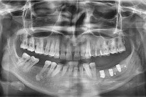 Navigierte Implantatversorgung im Unterkiefer nach zweizeitiger Augmentation