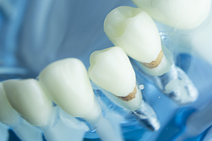 Forscher testen neue Methode zur Periimplantitisbehandlung