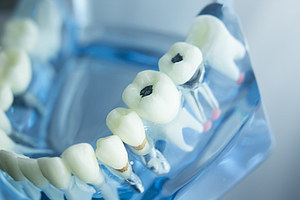 Speichelpeptide verbessern die Osseointegration von Implantaten