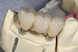 Implantate: OSA erhöht Risiko für Komplikationen