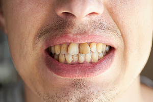 Studie: Mangelnde Mundhygiene begünstigt schwerste Corona-Verläufe