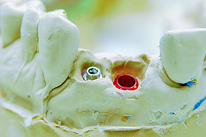 Misserfolge in der Zahnimplantologie: Was sind die Gründe?