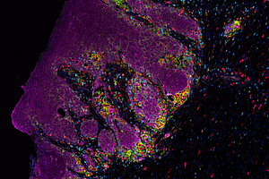 HNO-Krebs verstehen: Blick ins Mikromilieu von Kopf-Hals-Tumoren