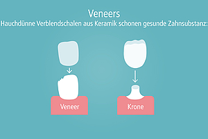 Patienteninfo Zahn-Veneers: Wann sind sie sinnvoll?