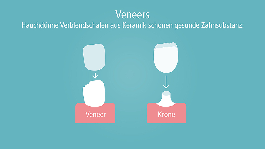 Patienteninfo Zahn-Veneers: Wann sind sie sinnvoll?