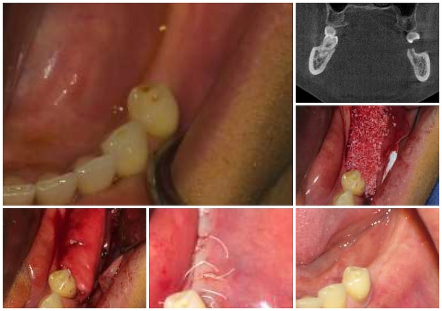 Navigierte Implantatversorgung im Unterkiefer nach zweizeitiger Augmentation