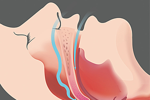 Schlafapnoe: Telemedizin bietet Chancen für kurzfristige Behandlungserfolge