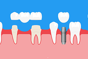 Welcher Zahnersatz ist der Richtige für mich?