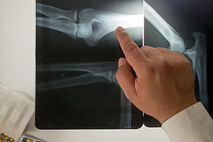 Osteoporose und Krebs: Bei Therapie mit Knochenstabilisatoren auf Kiefer achten!