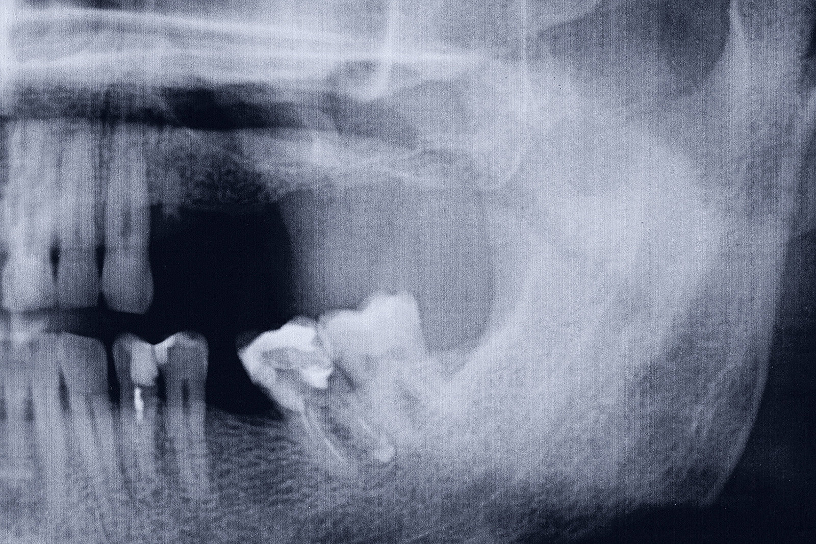 Parodontale Regeneration vertikaler Knochendefekte – was, wann und wie?