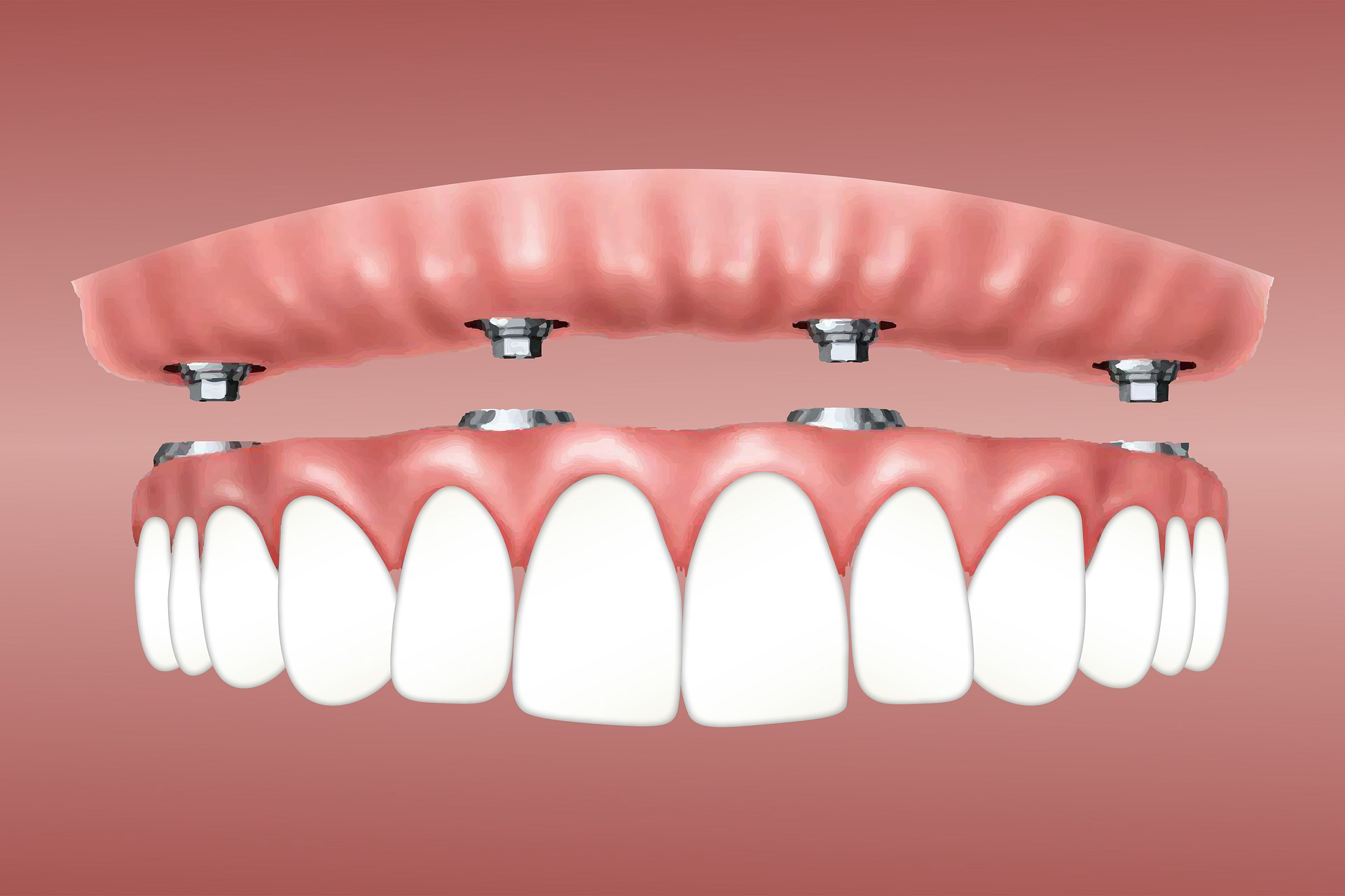 Korrekte Dokumentation und Abrechnung von Suprakonstruktionen in der Implantatprothetik