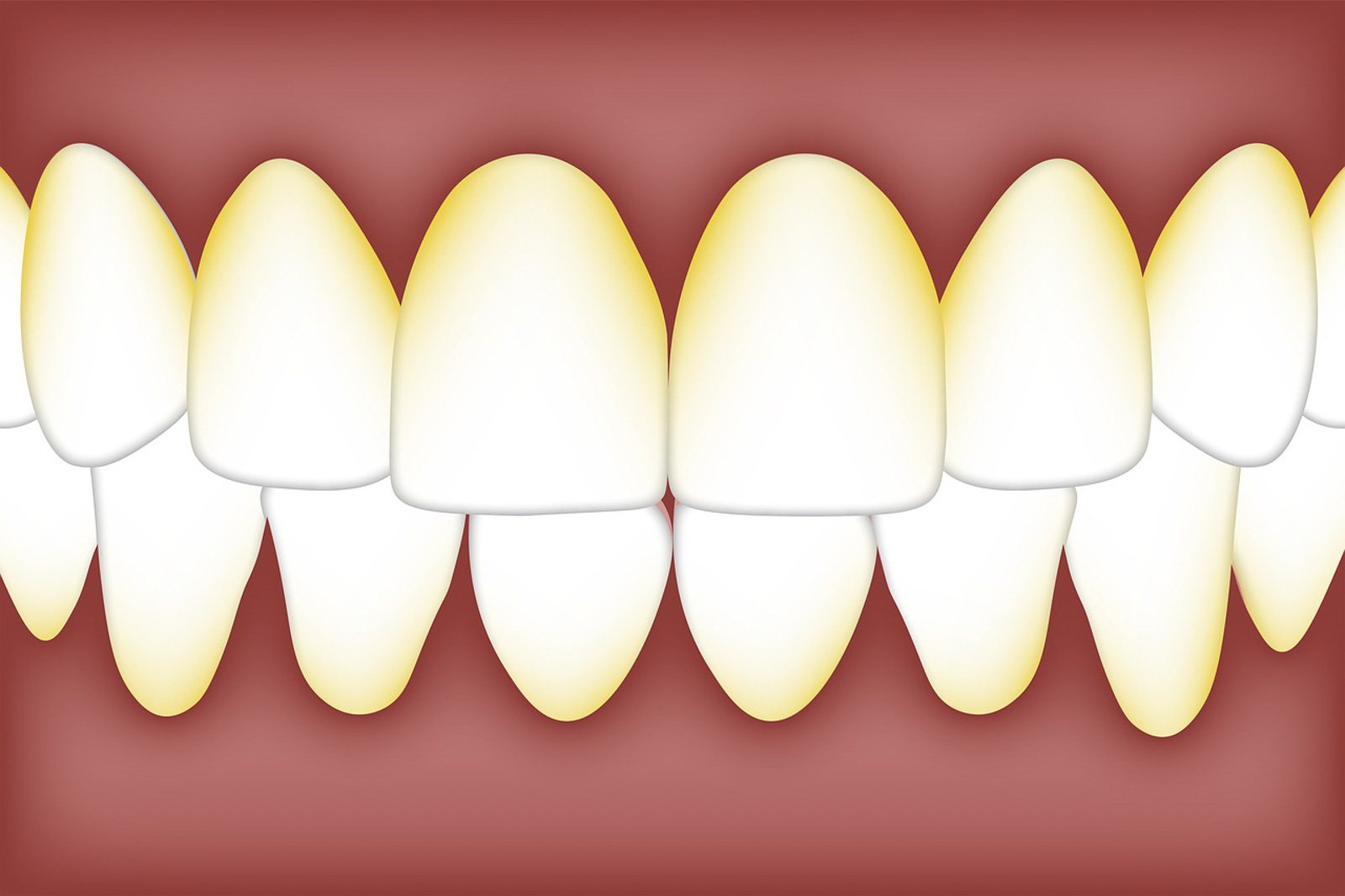 Wir haben was gegen Biofilm – Interdentalreinigung zwischen Wissenschaft, Wunsch und Wirklichkeit Wir haben was gegen Biofilm – Interdentalreinigung zwischen Wissenschaft, Wunsch und Wirklichkeit