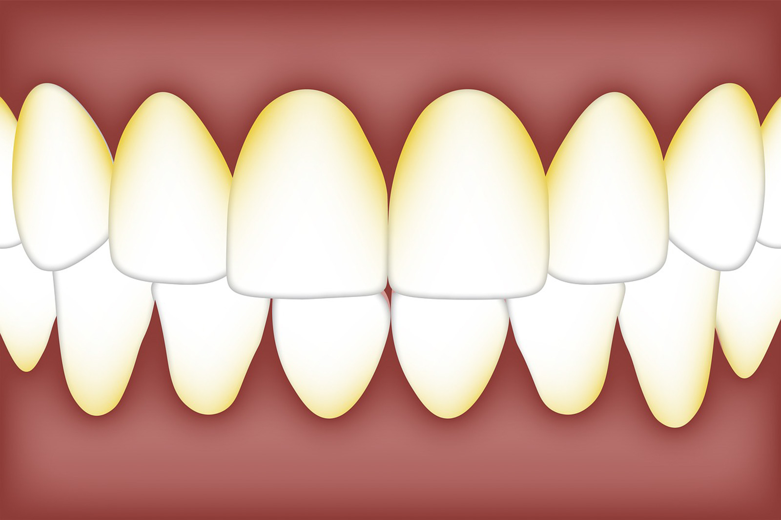 Wir haben was gegen Biofilm – Interdentalreinigung zwischen Wissenschaft, Wunsch und Wirklichkeit