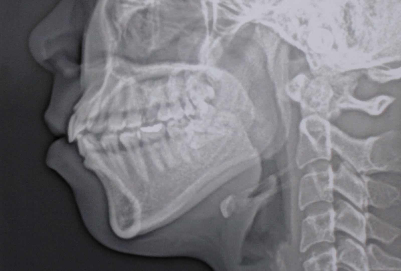 Regeneration komplexer Knochendefekte: Bone-Shield-Technik Regeneration komplexer Knochendefekte: Bone-Shield-Technik