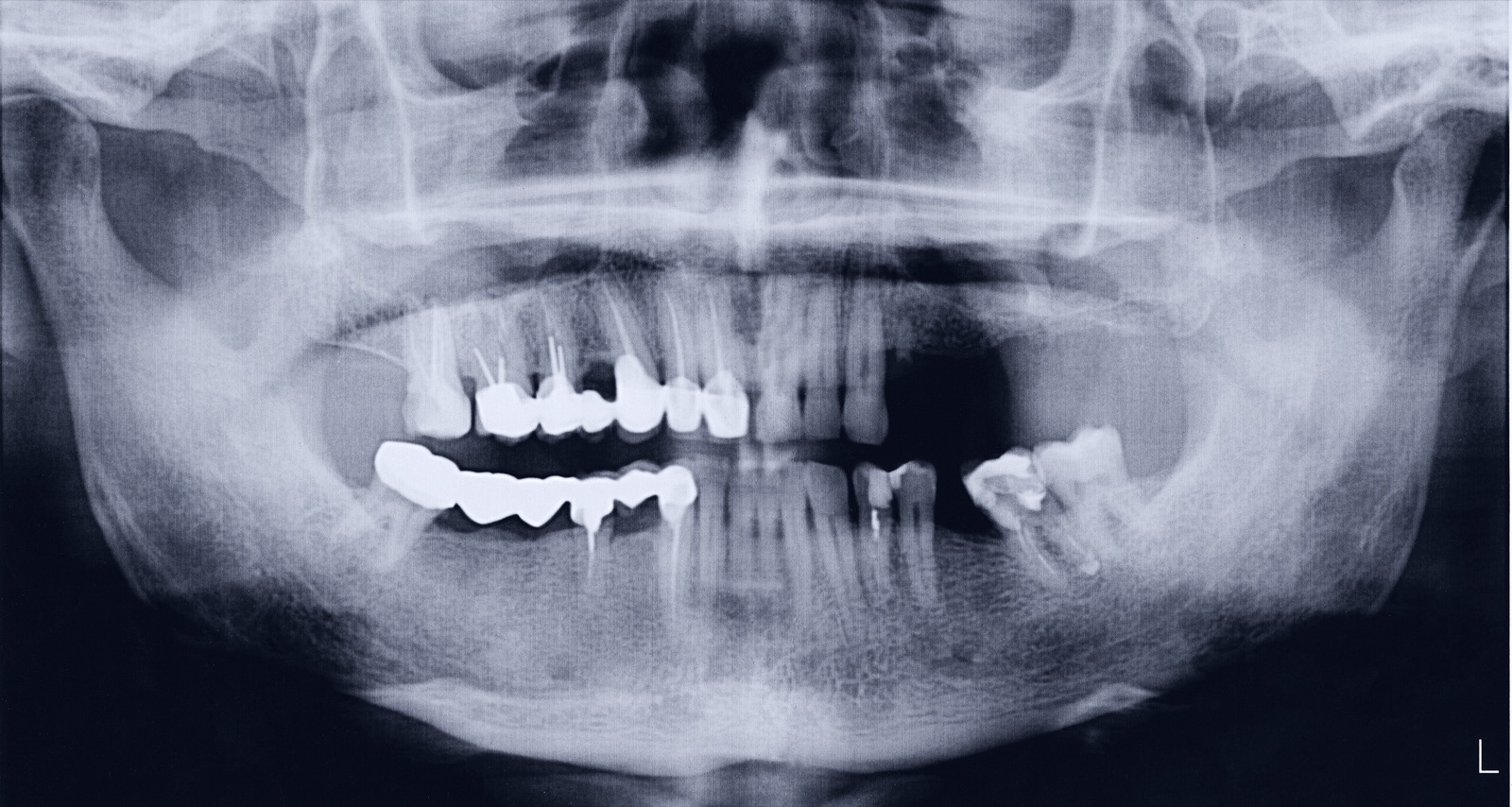 Osseodensification - Optimieren Sie Ihre Implantat-Präparation