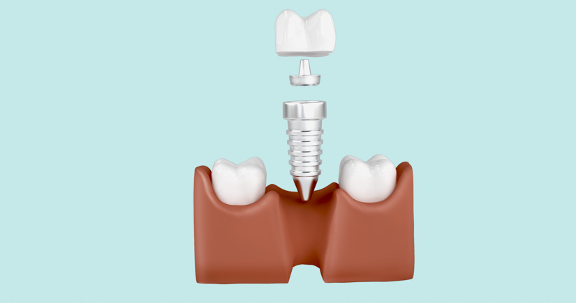Ästhetik: Abutment-Wahl beeinflusst die Papillenstabilität