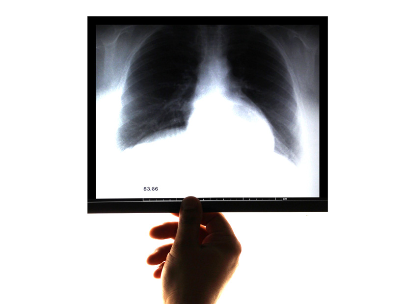 Zahnärzte & Personal: Risikogruppe für tödliche Lungenkrankheit?