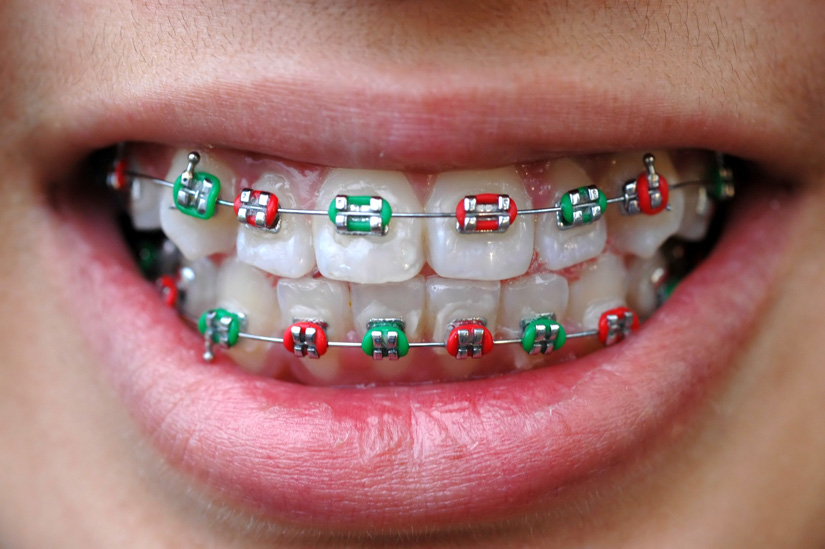 Metallstück einer Zahnspange bringt Jugendliche in Lebensgefahr