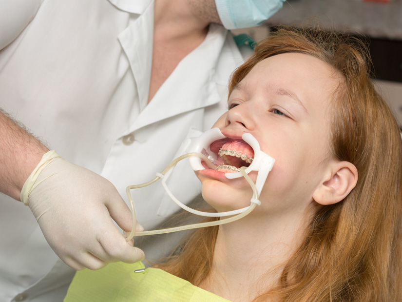 Unsachgemäße KFO-Behandlung verschlimmert Zahnfehlstellungen