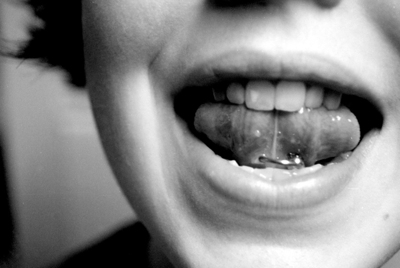 Zusammenhang zwischen Piercings und Parodontitis aufgedeckt