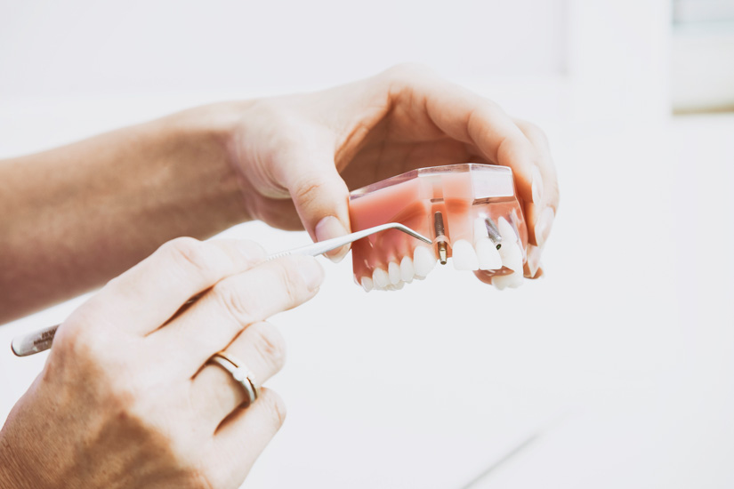 DGI-Empfehlung: Implantate pflegen wie natürliche Zähne
