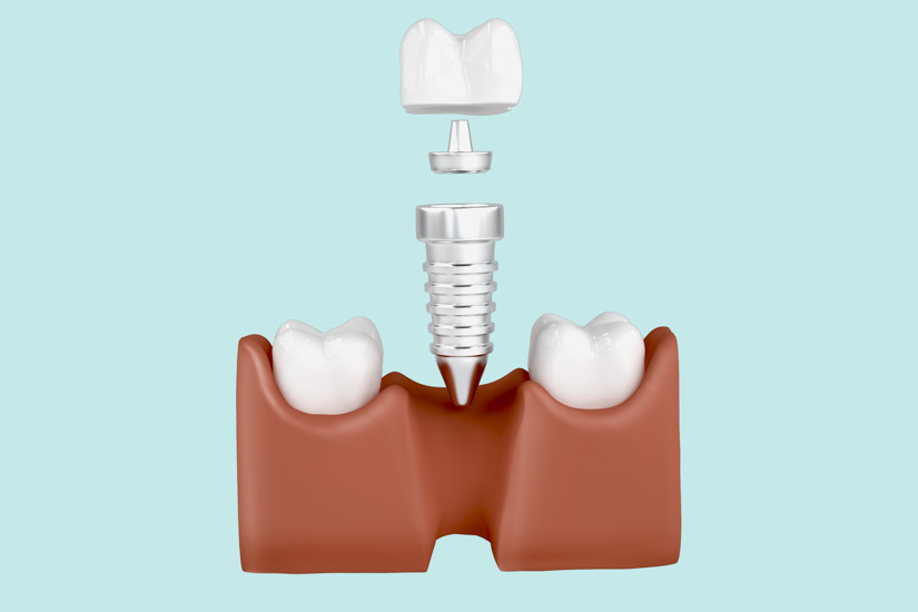 Studie zur Qualität dentaler Implantate: Erhebliche Unterschiede