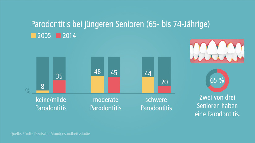 Achtung Parodontitis: Zahnfleisch regelmäßig kontrollieren lassen!